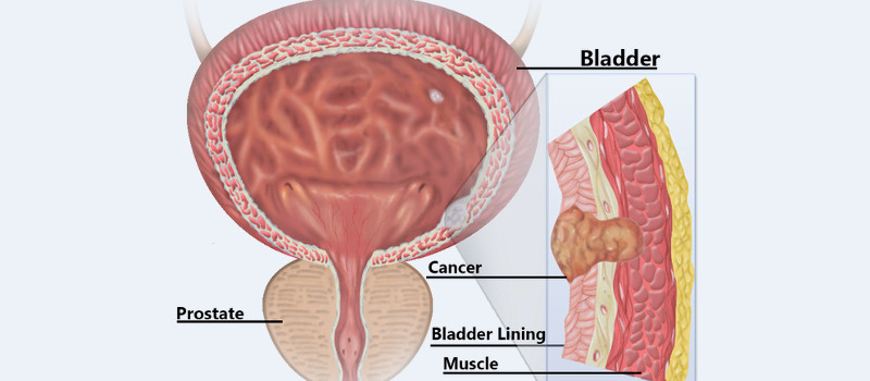kidney stone disease 1